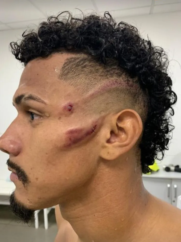 Sobral mostrou cicatrizes após a partida | Foto: Reprodução | Redes Sociais