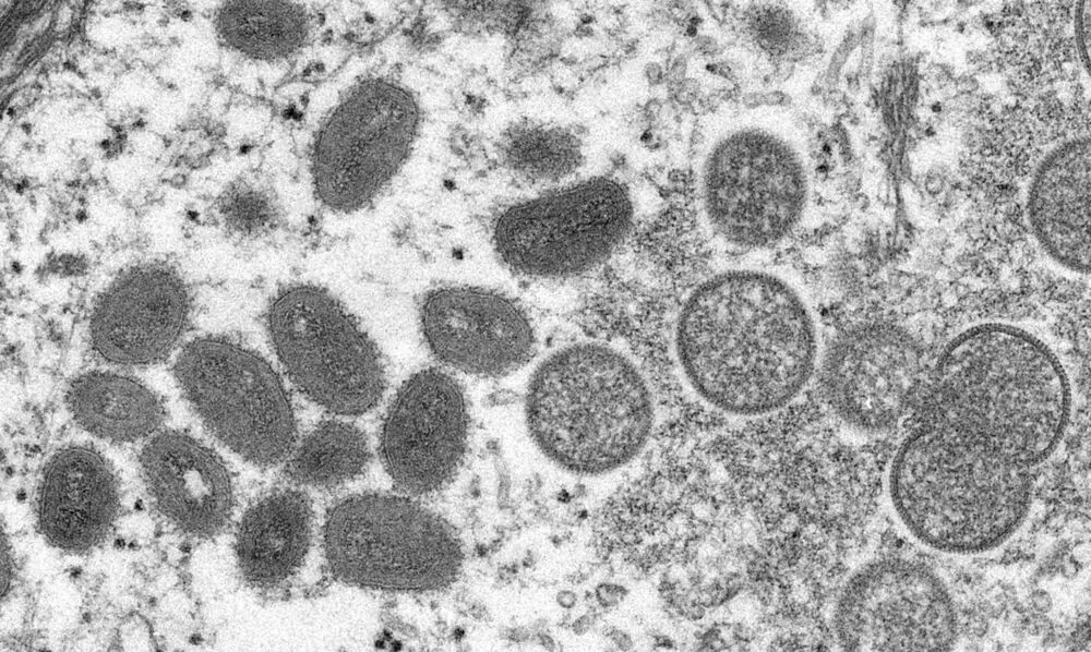 Segundo o instituto, entre 2018 e 2021 foram relatados sete casos de varíola dos macacos no Reino Unido