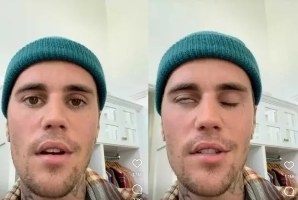 Cantor Justin Bieber com metade do rosto paralisado