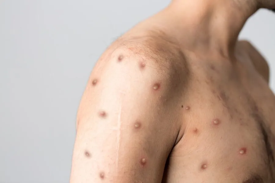 A varíola causada pelo vírus hMPXV (Human Monkeypox Virus, na sigla em inglês) causa uma doença mais branda do que a varíola smallpox, que foi erradicada na década de 80