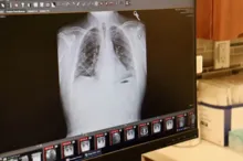 Imagem ilustrativa da imagem Transplante duplo de pulmão salva americano com câncer terminal