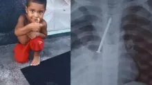 Imagem ilustrativa da imagem Criança morre na Bahia após passar 1 ano com prego no pulmão