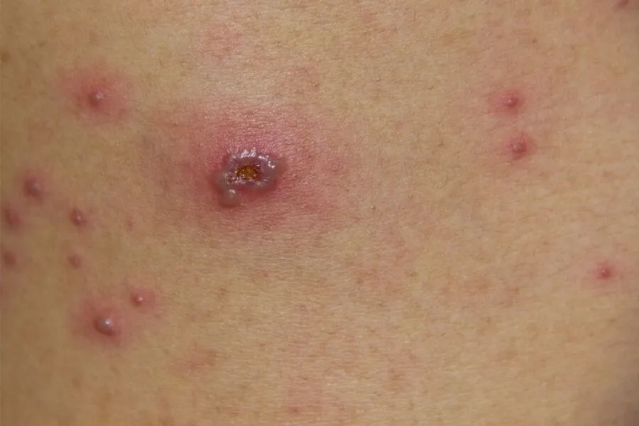 Doença que costuma produzir irritações na pele, como erupções cutâneas, a varíola assusta