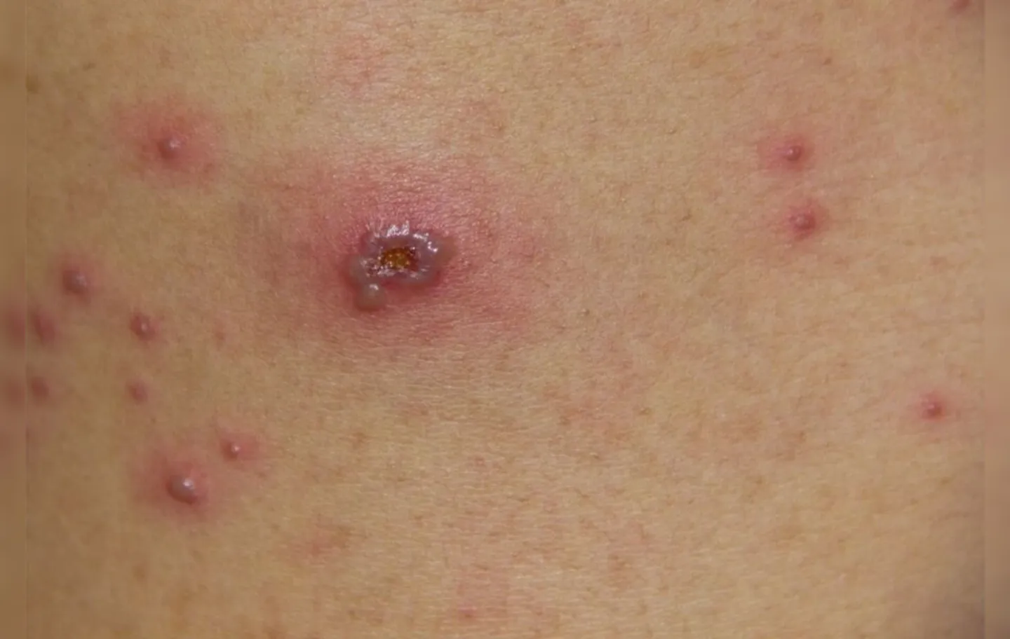 Doença que costuma produzir irritações na pele, como erupções cutâneas, a varíola assusta