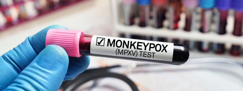 Sanitarista defende ampliar testagem e teme disseminação da varíola dos macacos no Brasil