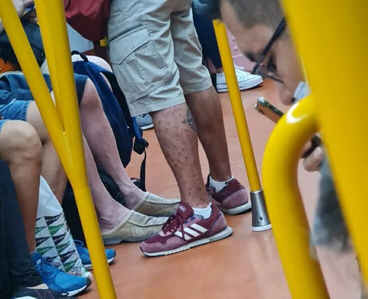Passageiro com varíola dos macacos andando de metrô em Madri, na Espanha, deixou médico chocado