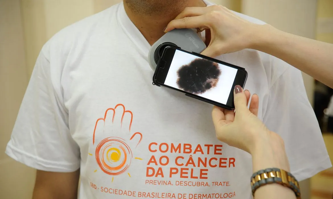 População deve observar manchas na pele