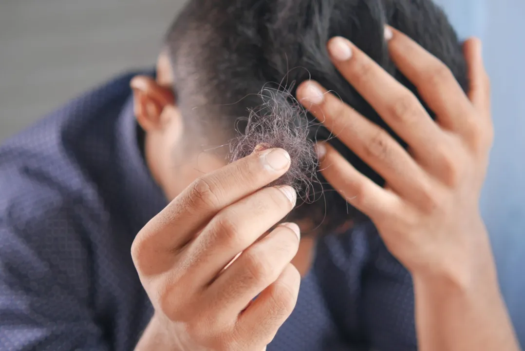 Imagem ilustrativa da imagem Nove em cada dez jovens sofrem ansiedade por medo de ficar careca