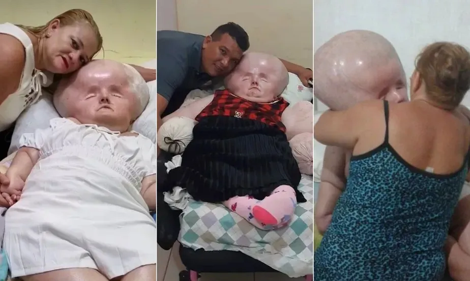 Brasileira com hidrocefalia completa 29 anos de idade