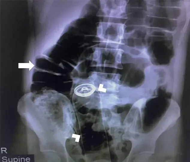 Imagem ilustrativa da imagem Homem insere tubo de desodorante no ânus, perde e passa por cirurgia