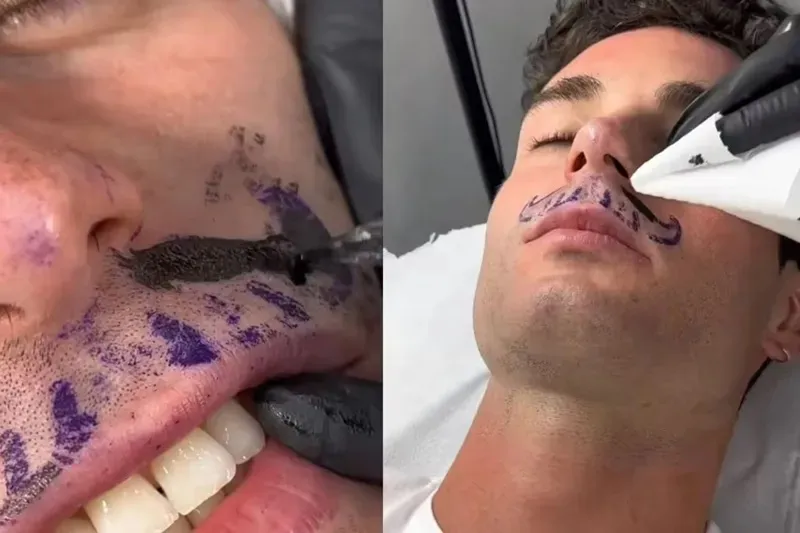 Homem retirou o bigode para tatuar um bigode no rosto