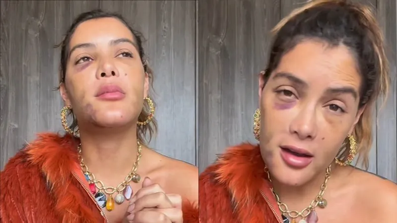 Imagem ilustrativa da imagem Marcella Maia descobre tumor no rosto após receber silicone industrial