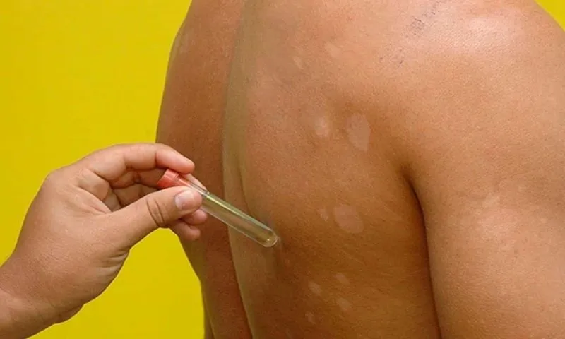 Em 2022, mais de 17 mil novos casos de hanseníase foram diagnosticados no país