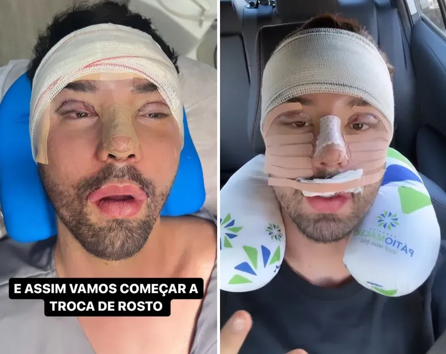 Imagem ilustrativa da imagem "Não aguentava mais ser chamado de feio", diz Rico pós cirurgia facial