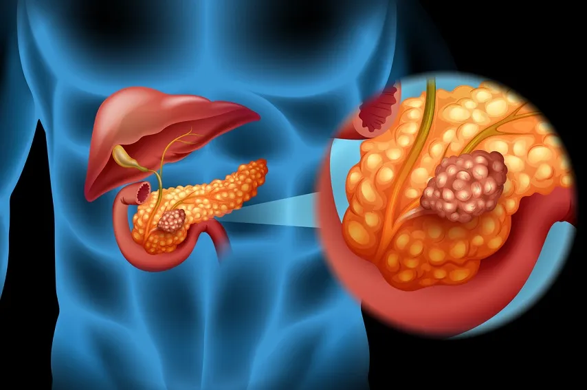 Imagem ilustrativa da imagem Câncer de pâncreas aumenta incidência em países industrializados