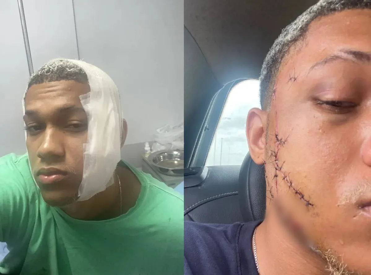 Jovem leva 37 pontos no rosto após ser agredido em festa