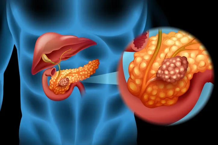 Imagem ilustrativa da imagem Câncer de pâncreas aumenta incidência em países industrializados