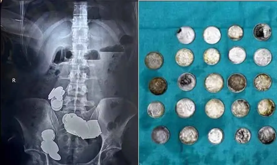 As radiografias mostram enormes coágulos metálicos se formando nos intestinos do jovem