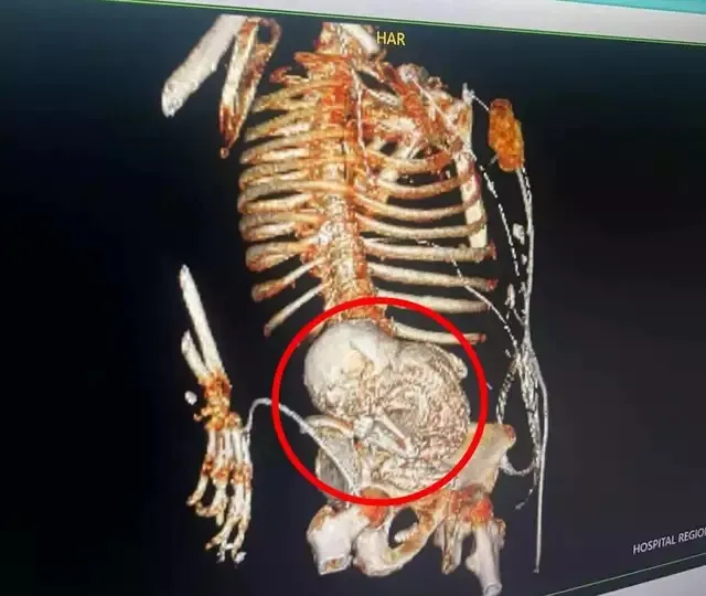 Tomografia computadorizada em 3D revelou o feto calcificado