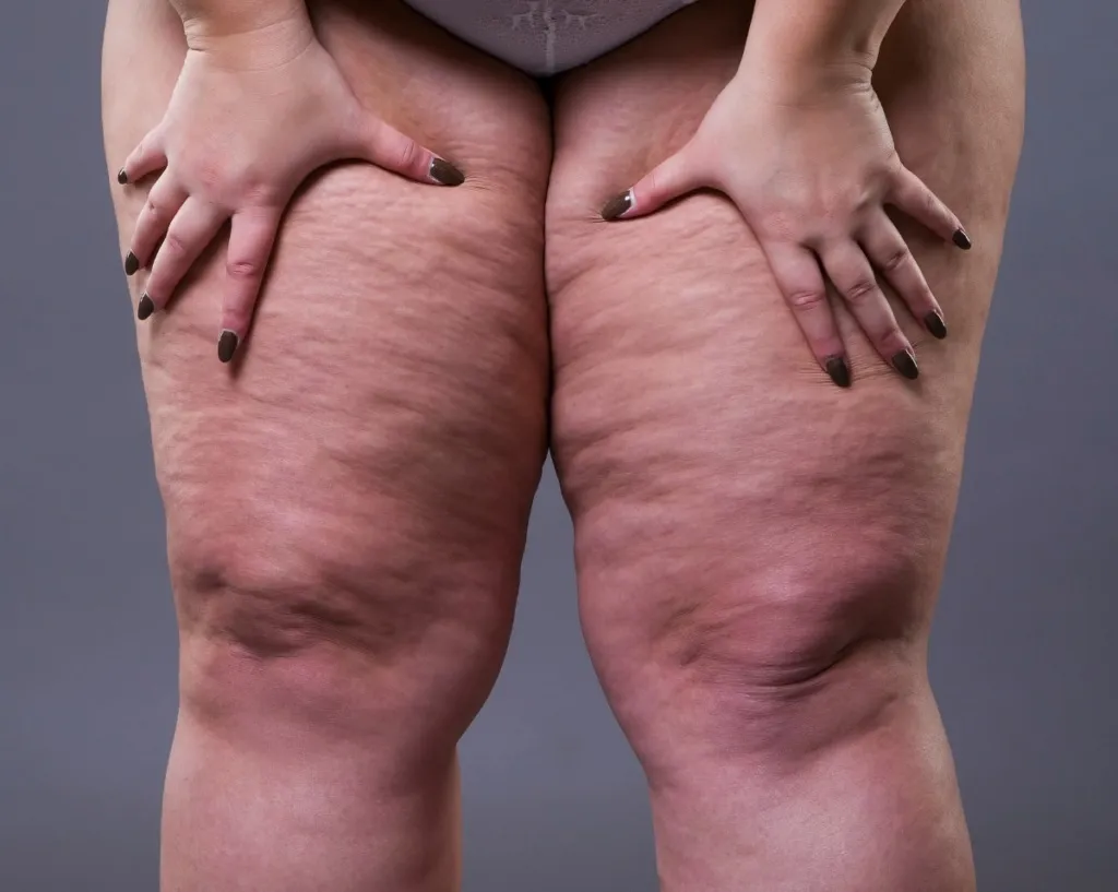 Lipedema é uma condição caracterizada pelo acúmulo anormal de gordura, geralmente nas pernas e nas coxas
