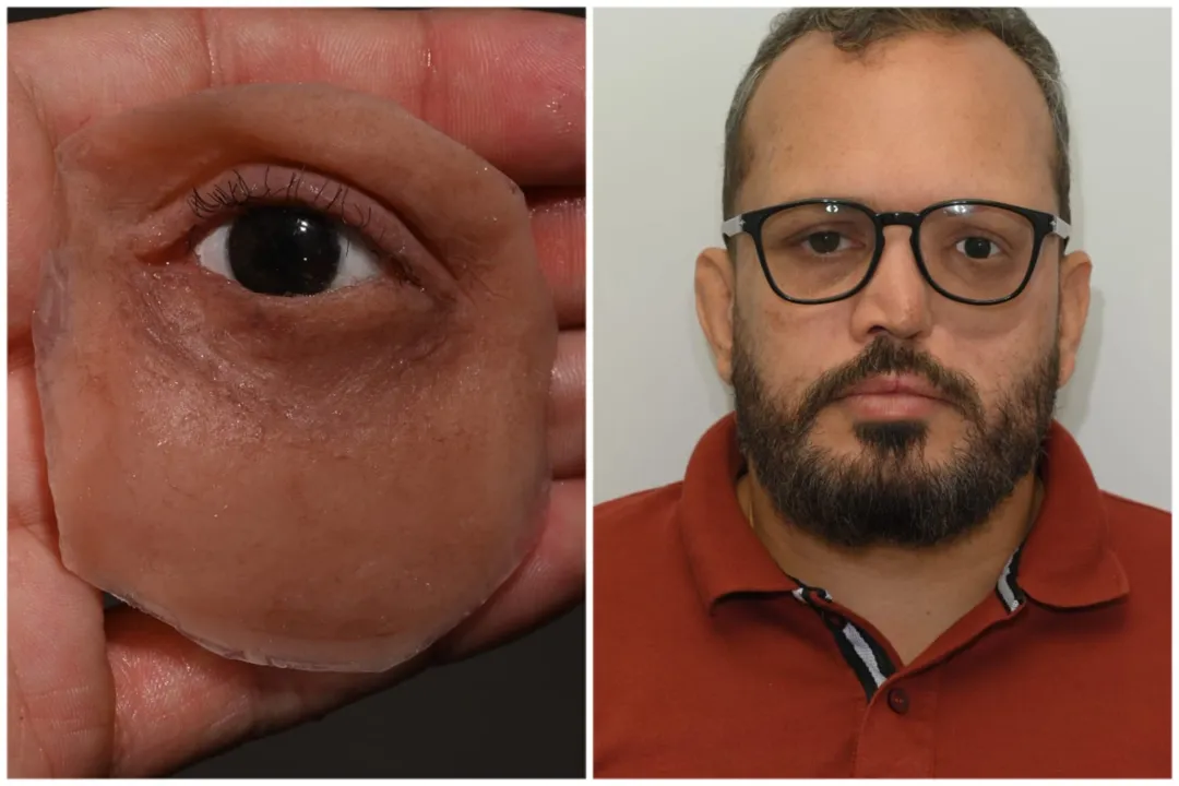 Custo da prótese é elevado e repasse do SUS muito baixo