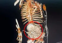 Paciente descobre feto mumificado no útero por mais de 50 anos