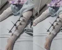 Imagem ilustrativa da imagem Médicos colocam pinos em perna errada de menina de 6 anos na Paraíba