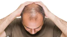 Imagem ilustrativa da imagem Pessoas com alopecia podem ganhar cirurgia gratuita pelo SUS