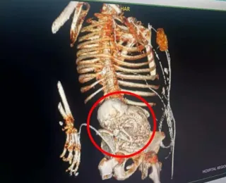 Paciente descobre feto mumificado no útero por mais de 50 anos