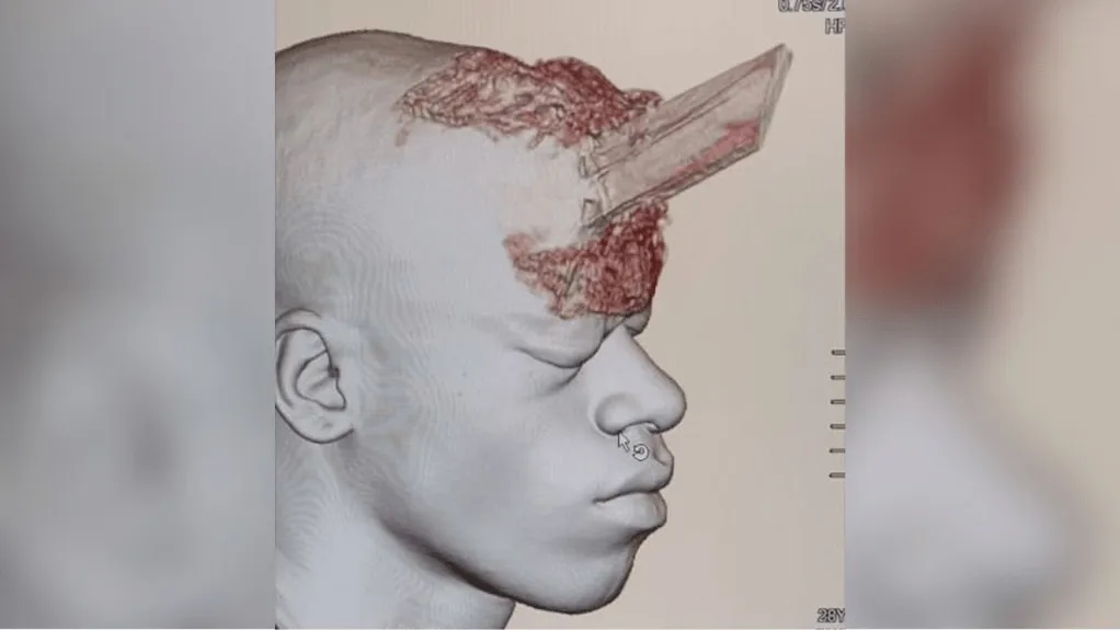 Imagem do crânio de homem que sofreu perfuração de 6 centímetros por uma estaca de madeira
