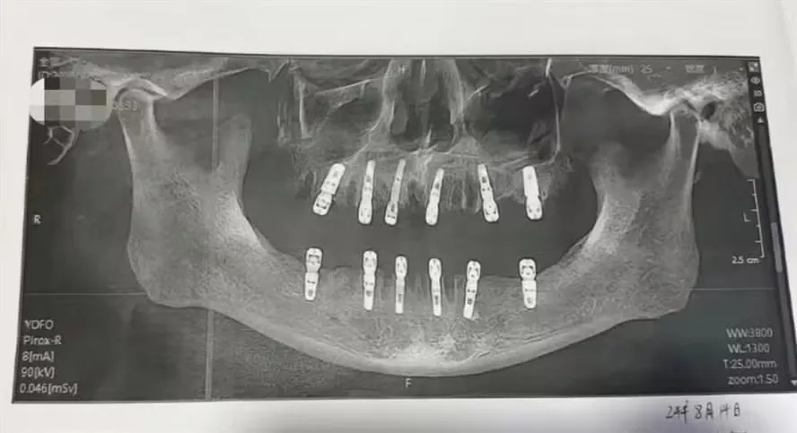 Imagem ilustrativa da imagem Homem morre após passar por cirurgia em que extraiu 23 dentes