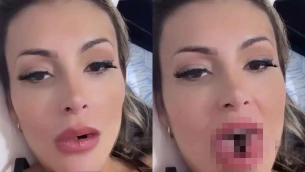 Imagem ilustrativa da imagem Língua de cobra: Saiba quanto custou cirurgia de Andressa Urach