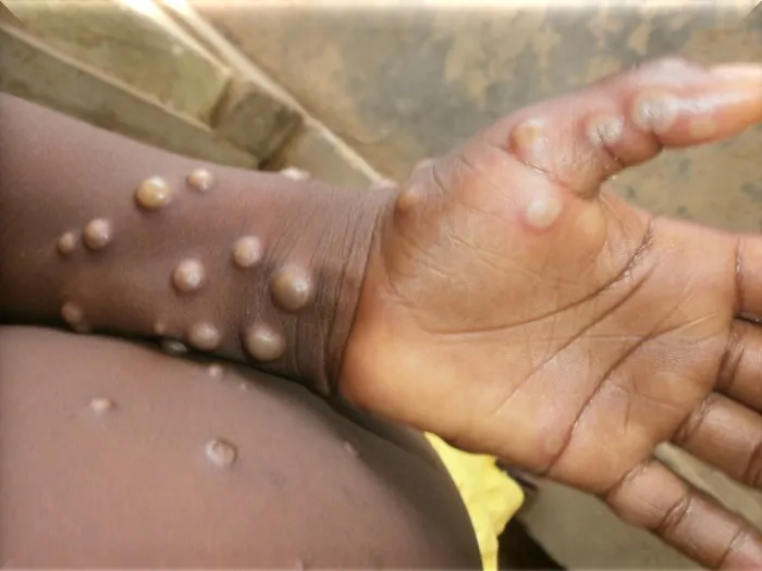 Entre 2022 e 2023, a mpox já havia figurado como emergência global em meio à propagação do vírus em diversos países