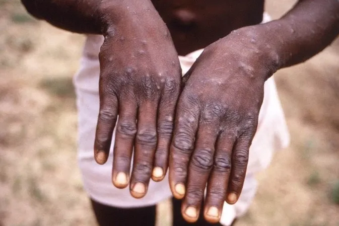 Imagem ilustrativa da imagem Mpox no Brasil: qual o perfil dos infectados pela doença? Confira