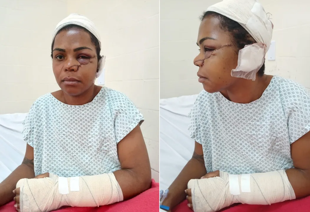 Mulher foi ferida no rosto pelo ex-companheiro