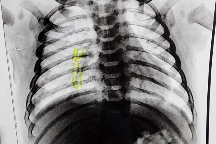 Homem é preso suspeito de quebrar costelas de enteado de 2 meses