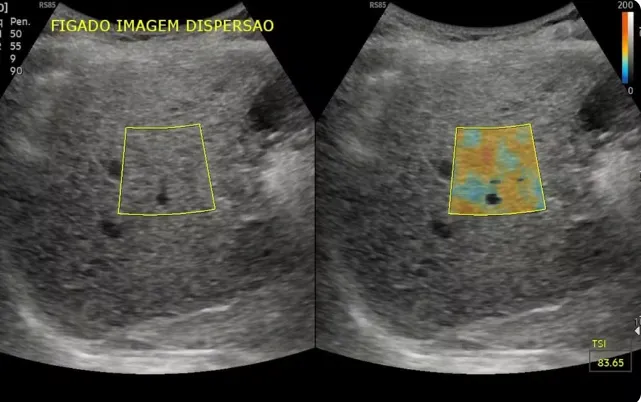 Exames incluem ultrassom, ressonância magnética e elastografia