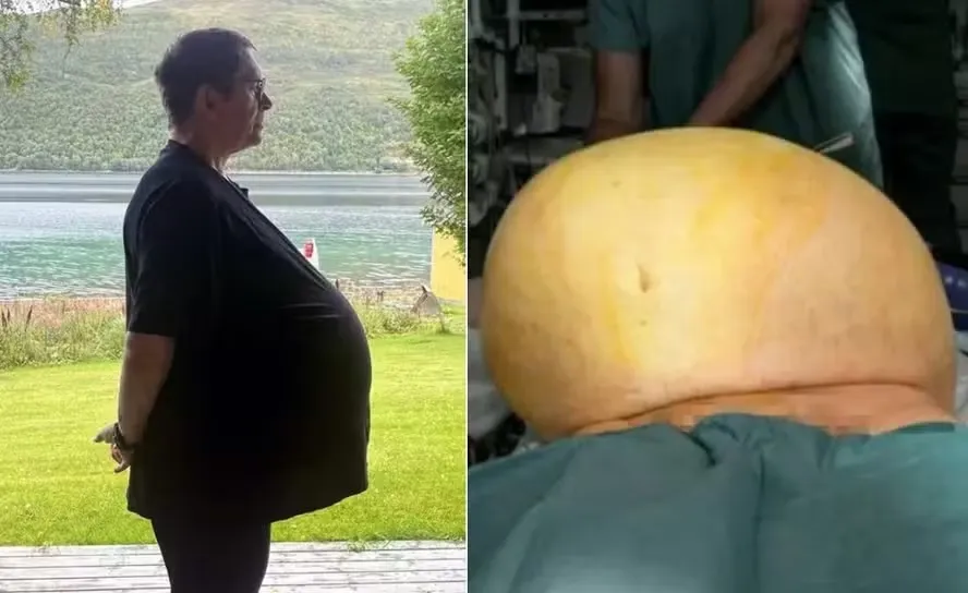 Imagem ilustrativa da imagem Homem descobre tumor de 27 kg após diagnóstico de obesidade