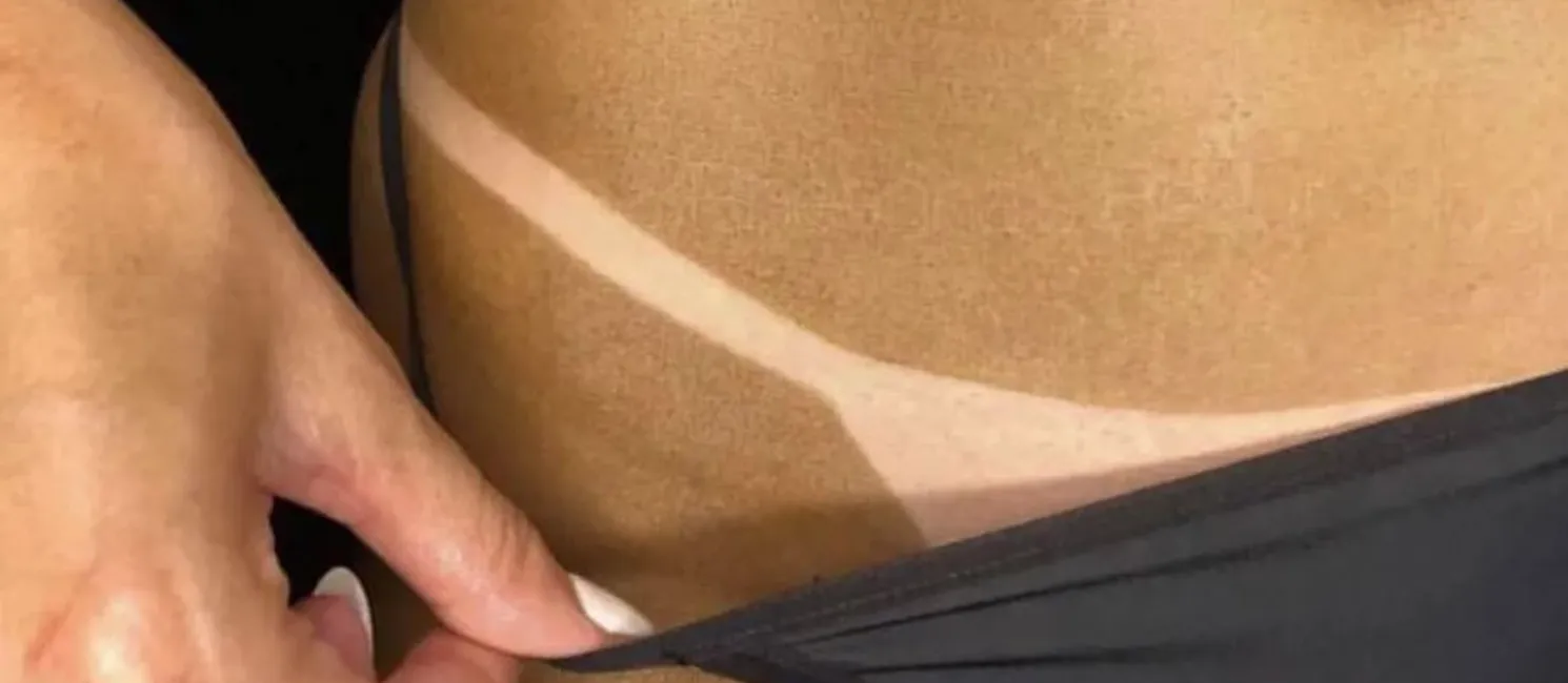 Imagem ilustrativa da imagem Bronzeamento artificial é proibido pela Anvisa; saiba os riscos