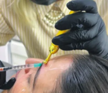 Imagem ilustrativa da imagem Cuidados no uso do botox evitam perda de dinheiro e problemas de saúde