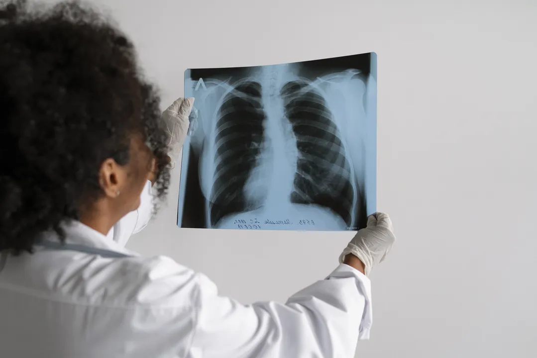 Campanha Agosto Branco é dedicada à conscientização e luta contra o câncer de pulmão