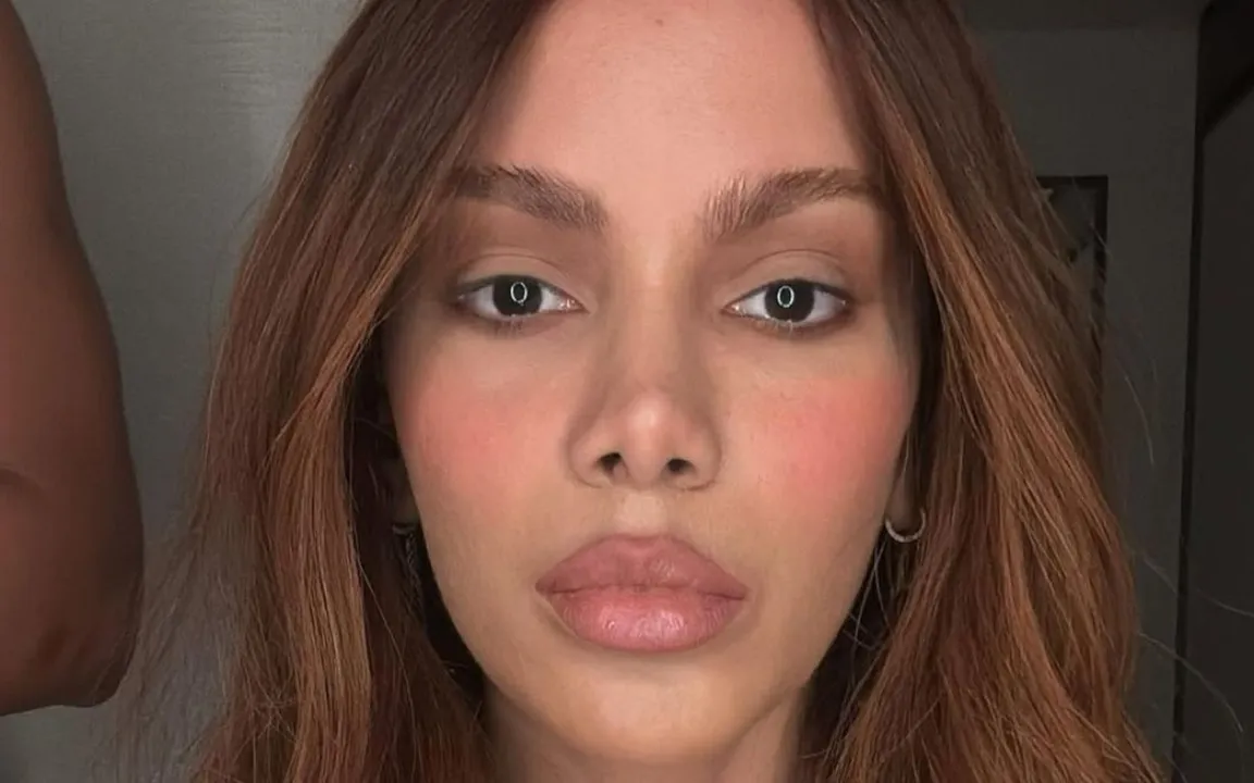 Anitta após as plásticas