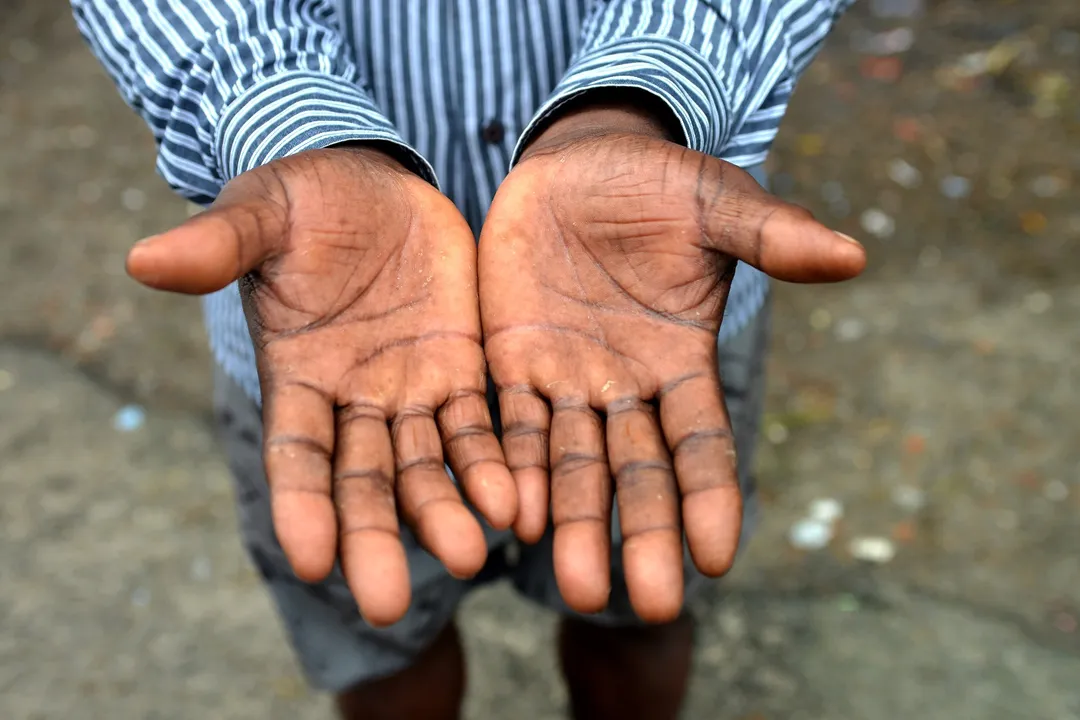 Trabalhador mostra as mãos
