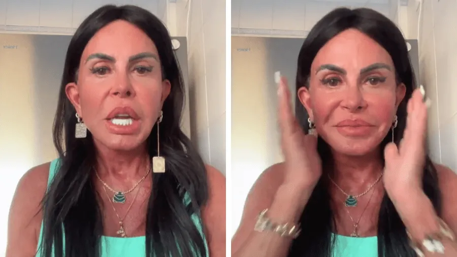 Gretchen mostrou o resultado de novo procedimento no Instagram
