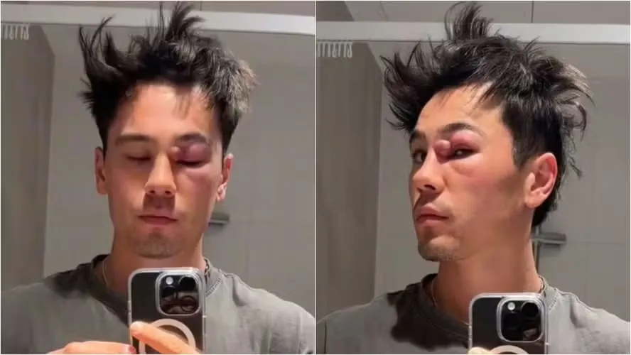 Morador de Melbourne, Kai Davidson, percebeu um pequeno caroço ao lado do nariz no fim de 2024
