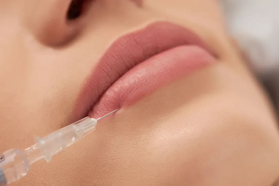 PMMA é usado em procedimentos como preenchimento labial