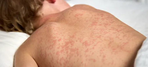 Casos de sarampo na Bolívia acendem alerta ao Brasil