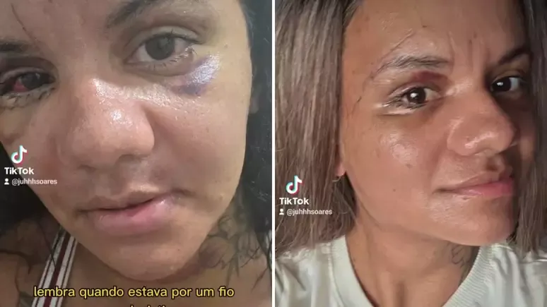 A tentativa de feminicídio gerou múltiplas fraturas no rosto da estudante de 35 anos