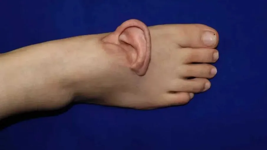 Cirurgia teve objetivo de deixar orelha viva