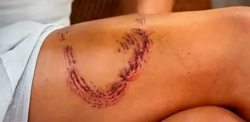 Turista mordida por tubarão em Fernando de Noronha mostra ferimento